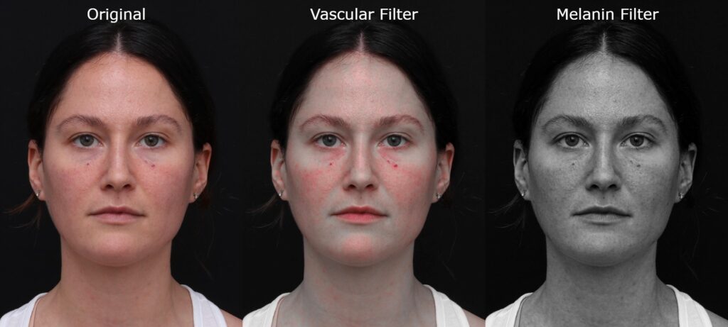 emily emr photography for aesthetic clinics medspas vascular and melanin filters